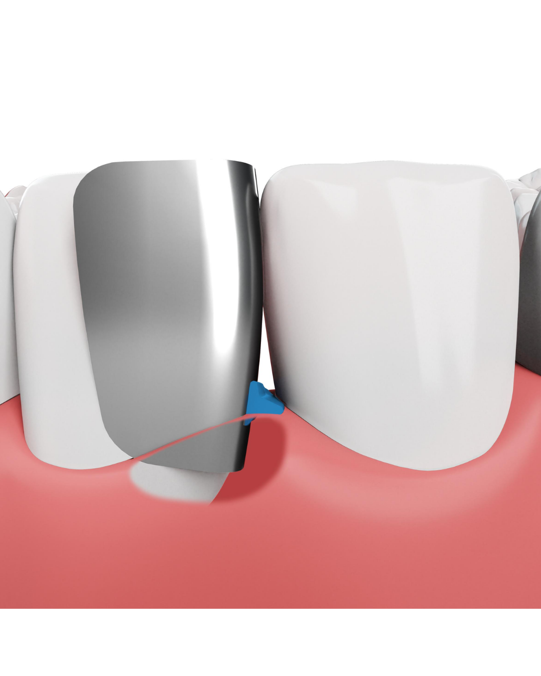 Composi-Tight 3D Fusion - Matrice Antérieure Fusion-3