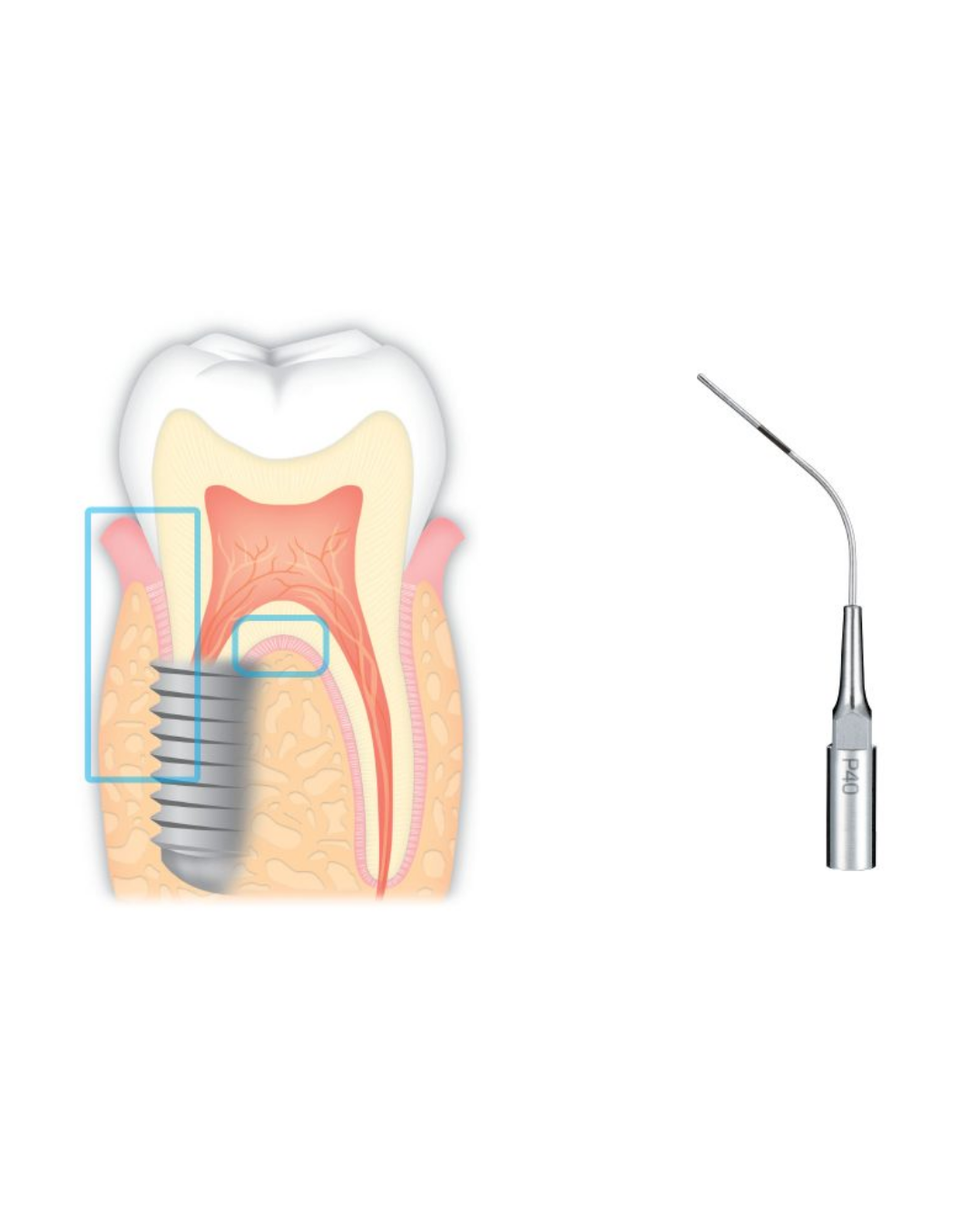 Insert Ultrasonique – Pério (Irrigation et nettoyage) - P41-1